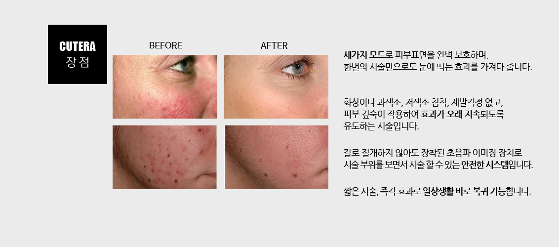 세가지 모드로 피부표면을 완벽 보호하며, 한번의 시술만으로도 눈에 띄는 효과를 가져다 줍니다.
				화상이나 과색소, 저색소 침착, 재발걱정 없고, 피부 깊숙이 작용하여 효과가 오래 지속되도록 유도하는 시술입니다.
				칼로 절개하지 않아도 장착된 초음파 이미징 장치로 시술 부위를 보면서 시술 할 수 있는 안전한 시스템입니다.
				짧은 시술, 즉각 효과로 일상생활 바로 복귀 가능합니다.