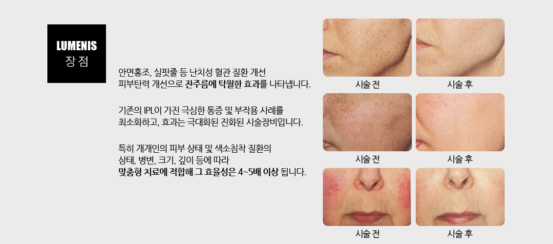 안면홍조, 실핏줄 등 난치성 혈관 질환 개선
				피부탄력 개선으로 잔주름에 탁월한 효과를 나타냅니다.
				기존의 IPL이 가진 극심한 통증 및 부작용 사례를최소화하고, 효과는 극대화된 진화된 시술장비입니다.
				특히 개개인의 피부 상태 및 색소침착 질환의 상태, 병변, 크기, 깊이 등에 따라 맞춤형 치료에 적합해 그 효율성은 4~5배 이상 됩니다.