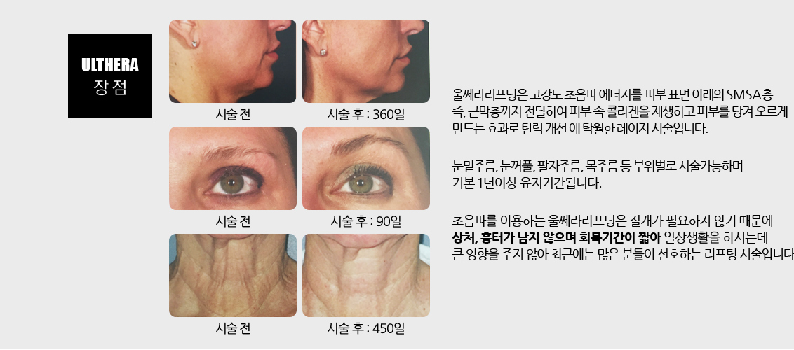 울쎄라리프팅은 고강도 초음파 에너지를 피부 표면 아래의 SMSA층
				즉, 근막층까지 전달하여 피부 속 콜라겐을 재생하고 피부를 당겨 오르게 만드는 효과로 탄력 개선 에 탁월한 레이저 시술입니다.
				눈밑주름, 눈꺼풀, 팔자주름, 목주름 등 부위별로 시술가능하며 기본 1년이상 유지기간됩니다.
				초음파를 이용하는 울쎄라리프팅은 절개가 필요하지 않기 때문에 상처, 흉터가 남지 않으며 회복기간이 짧아 일상생활을 하시는데  큰 영향을 주지 않아 최근에는 많은 분들이 선호하는 리프팅 시술입니다.